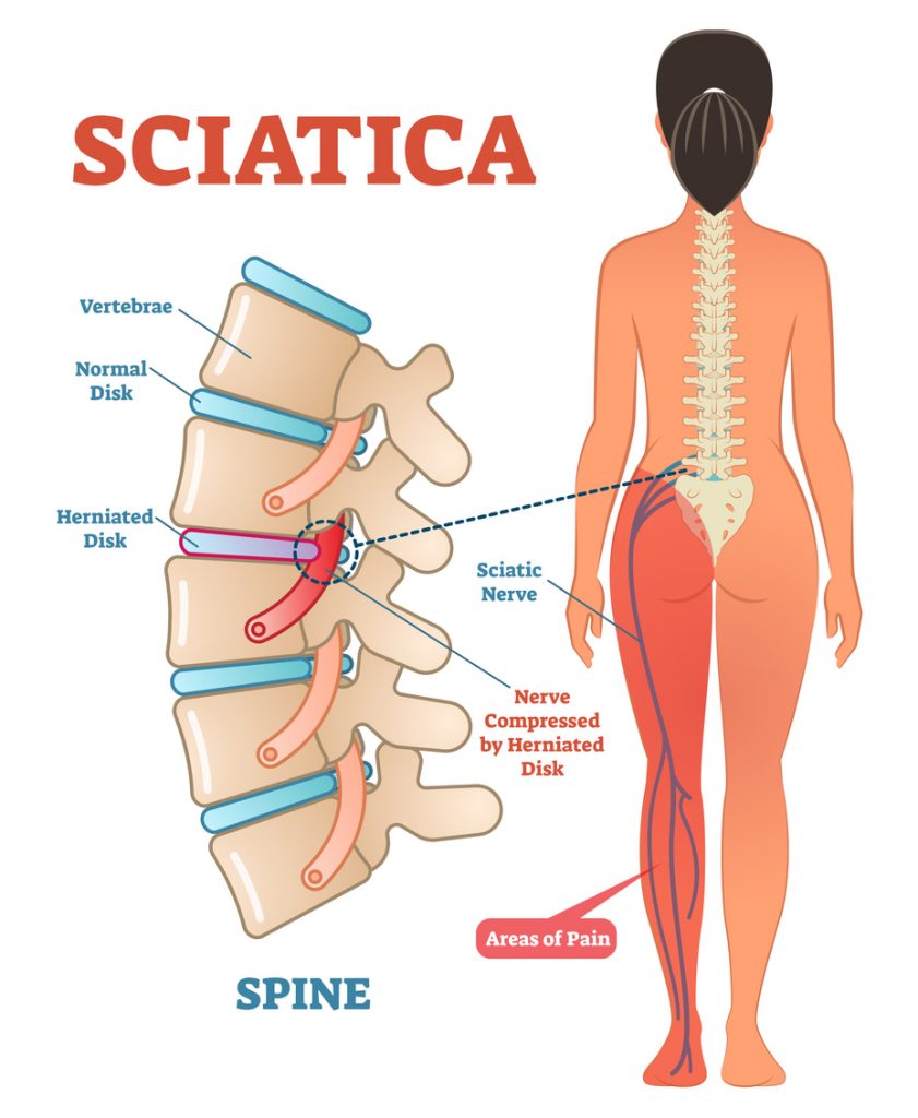 Sciatica Graphic Diagram | Singapore Chiropractic Sciatica Graphic Diagram | Singapore Chiropractic