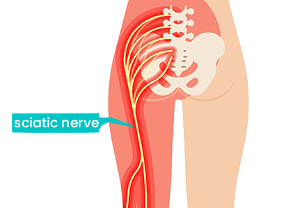 sciatica-nerve-close-up Sciatica-Nerve-Pain graphic close up